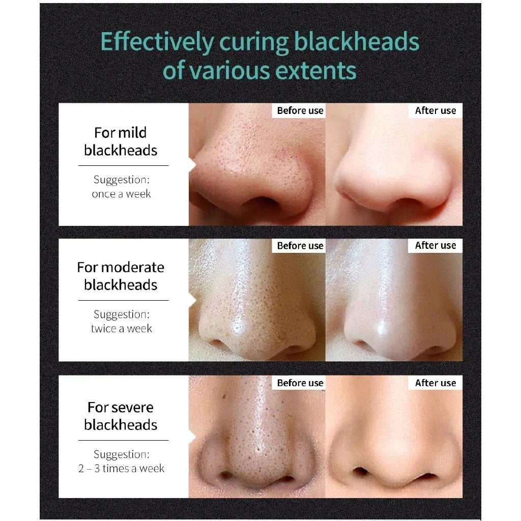 LANBENA Blackhead Remover Nose Mask